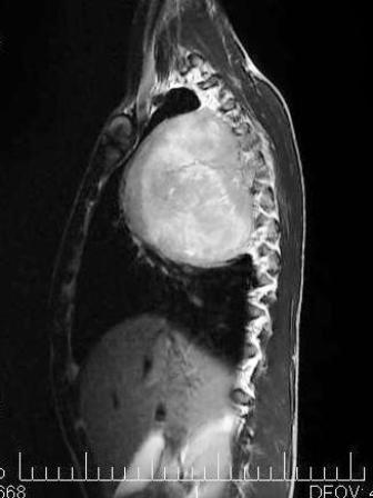 Figure 4: MRI coronal plane showing excellent soft tissue delineation
